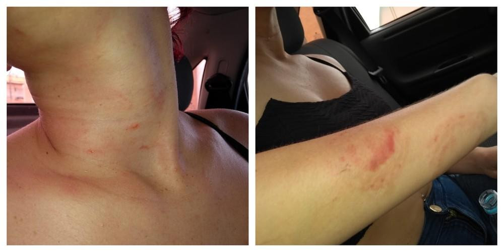 Garota é agredida com mordidas após namorado ter crise de ciúmes em SP